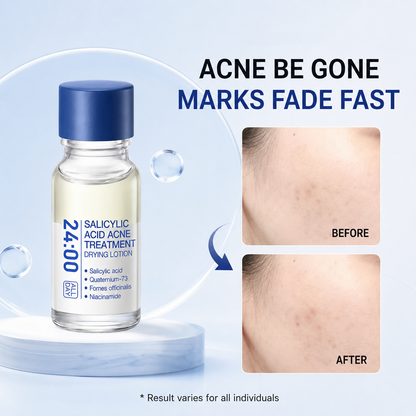 24H Acne & Pimple Treatment Lotion - Fast Relief