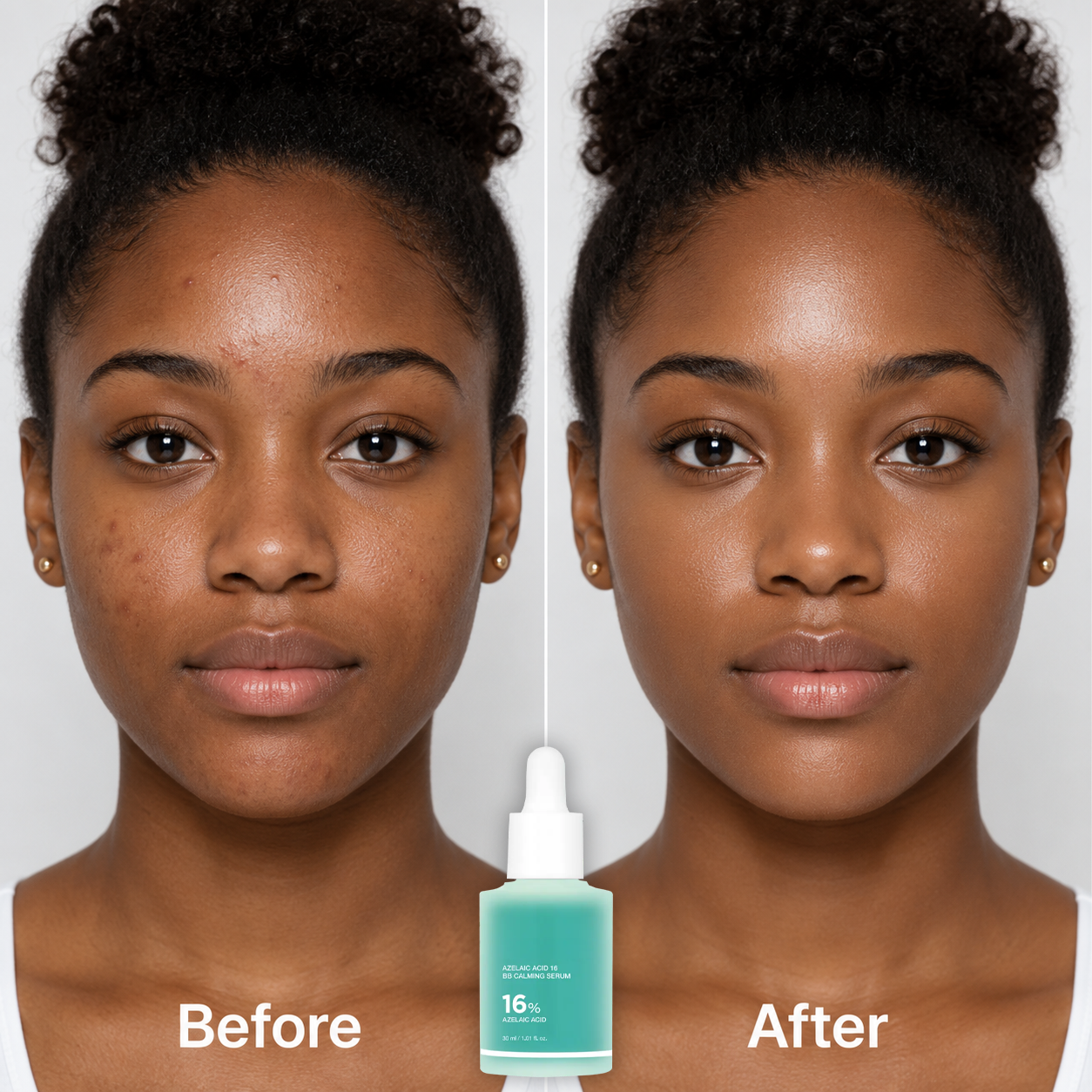 16% Azelaic Acid Calming Serum with Niacinamide and Vitamin B5