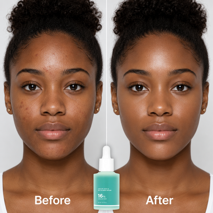 16% Azelaic Acid Calming Serum with Niacinamide and Vitamin B5