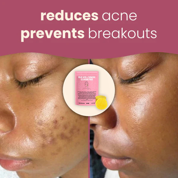 Brightening turmeric & kojic acid pads