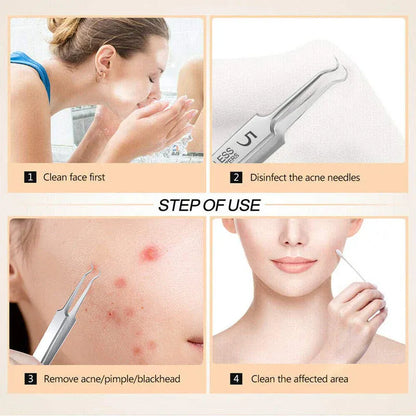 Femmekin 3-Piece Precision Blackhead Tweezer Set