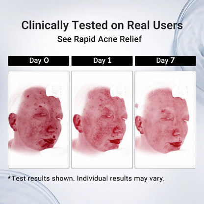 24H Acne & Pimple Treatment Lotion - Fast Relief